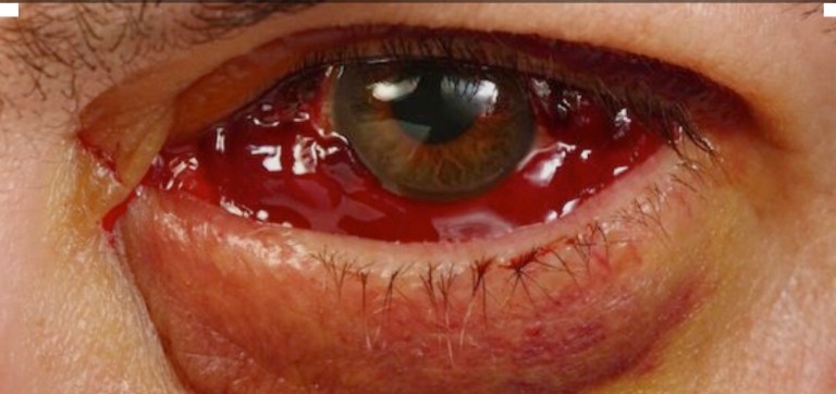 Found this on lookafteryoureyes.org - this is what my eye looked like